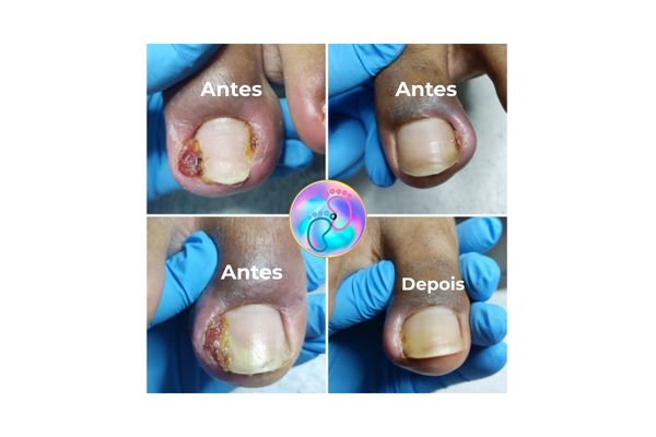 Foto de antes e depois do tratamento 15